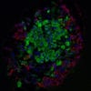 Could Beta Cell Age and Differentiation Play a Role in the Development of Diabetes?