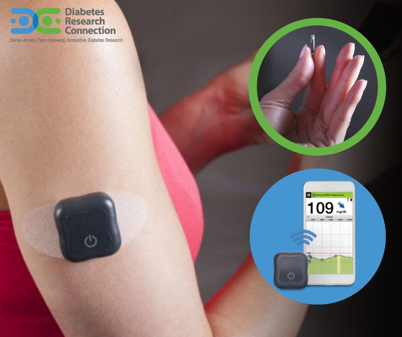 implantable continuous blood glucose monitor