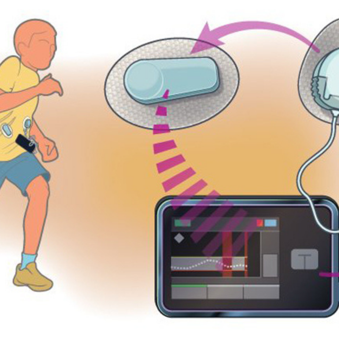 Improving Glycemic Control in Children Through Closed-Loop Systems